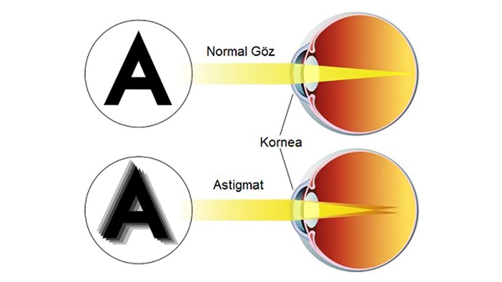 astigmat