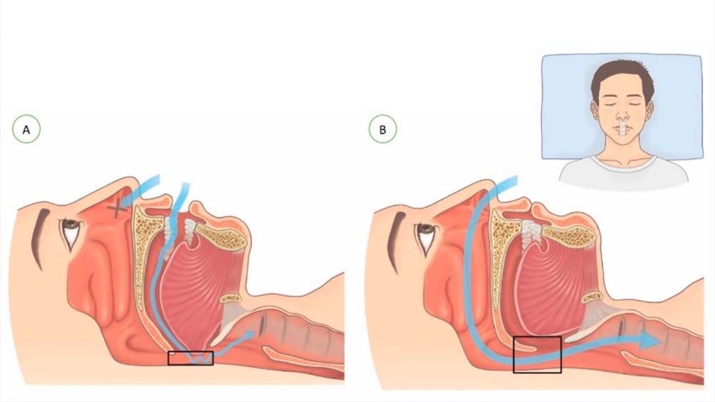 Mouth Taping